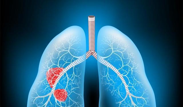 肺癌早期咳嗽会传染吗__肺癌的早期咳嗽会好吗
