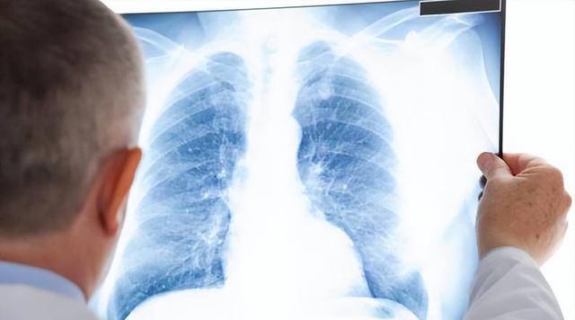 肺癌早期咳嗽会传染吗__肺癌的早期咳嗽会好吗